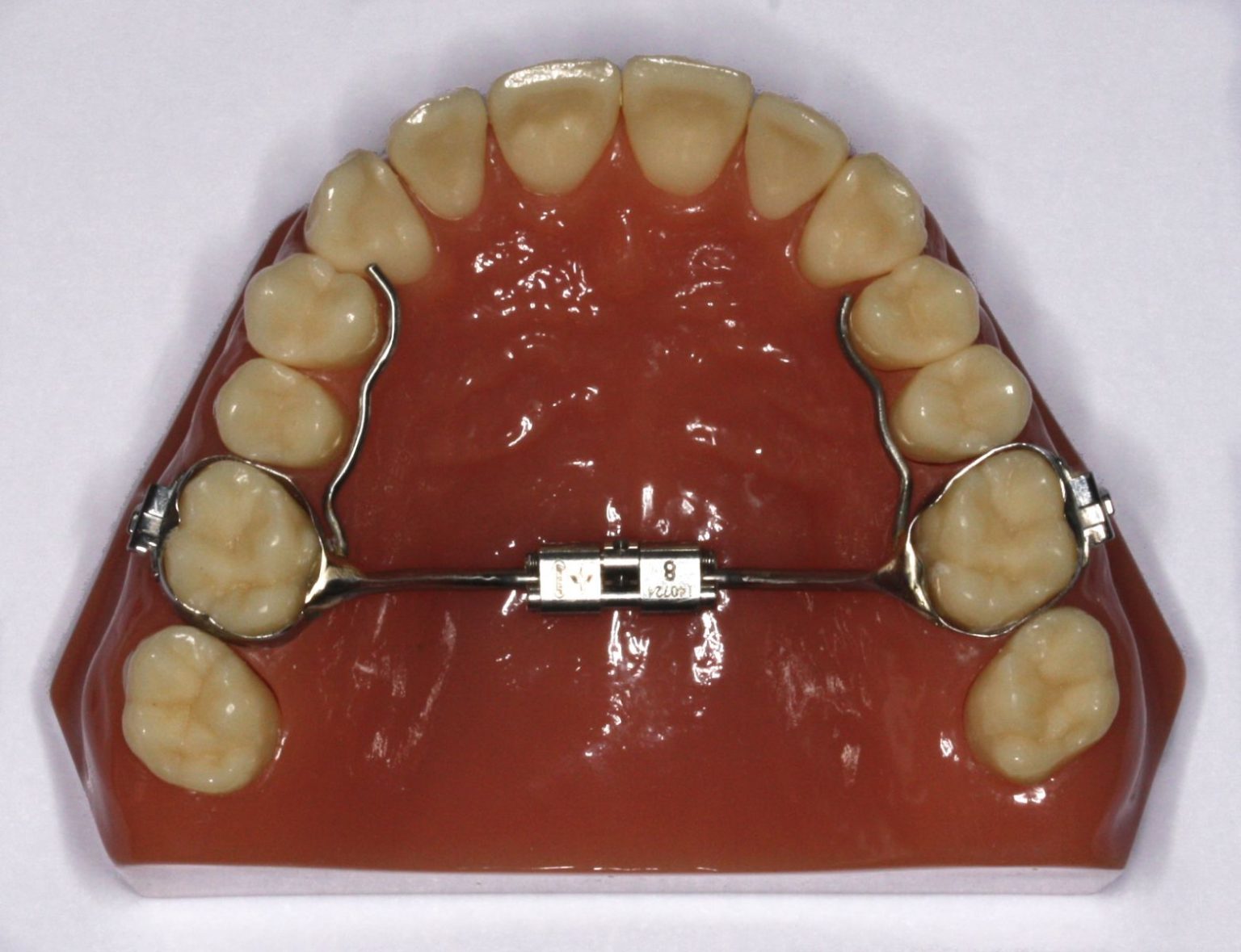 Palatal Expander Instructions by Williams Orthodontics Orthodontist