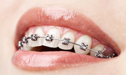 life with braces