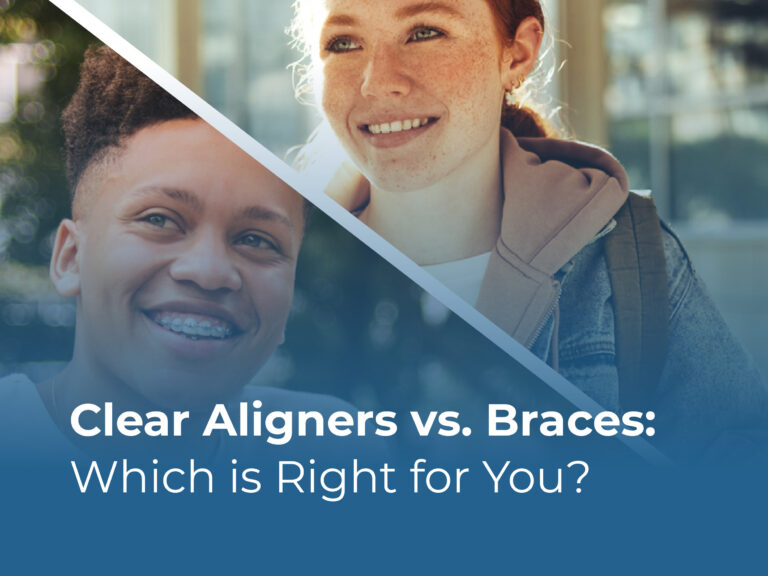 clear aligners vs braces