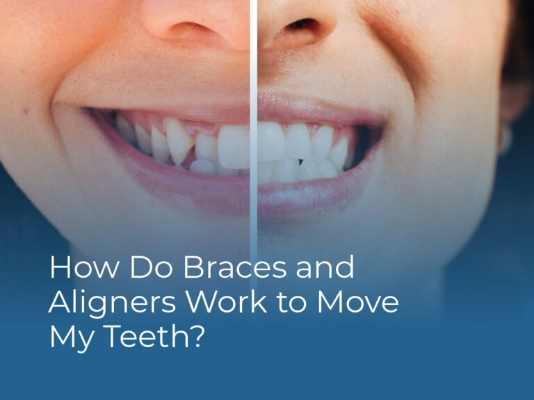 How Do Braces and Aligners Work to Move My Teeth?